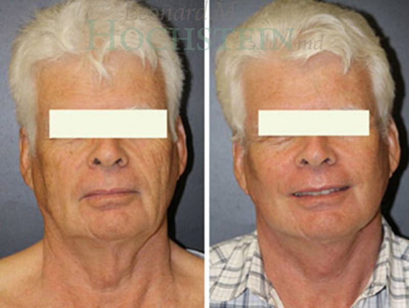 Facelift Patient