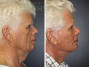 Facelift Patient