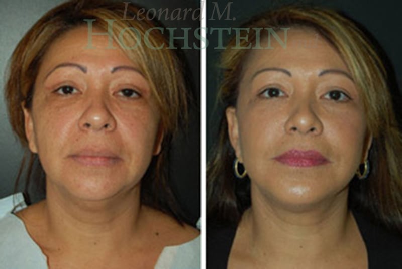 Facelift Patient
