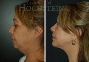 Facelift Patient
