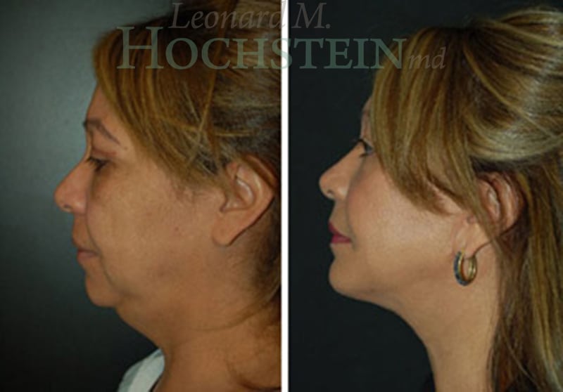 Facelift Patient