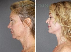 Facelift Patient