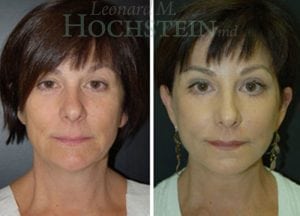 Facelift Patient