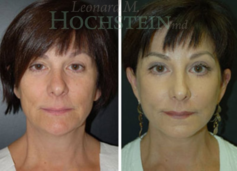 Facelift Patient