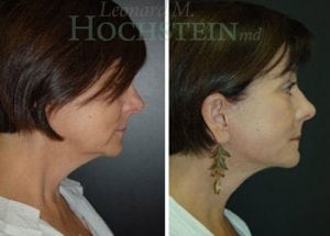 Facelift Patient