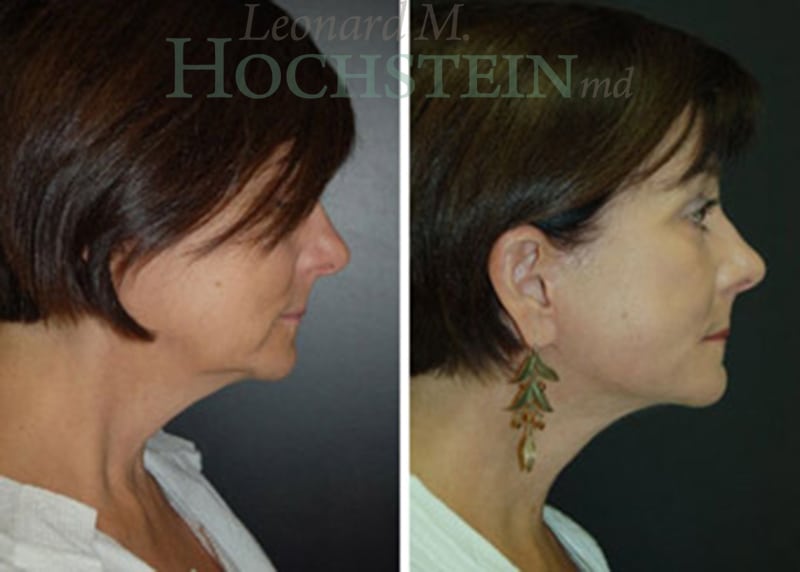 Facelift Patient