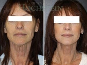 Facelift Patient
