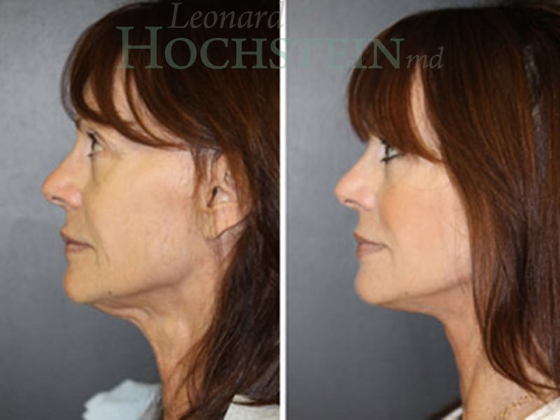 Facelift Patient