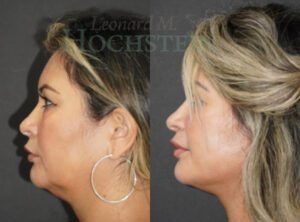 Facelift Patient