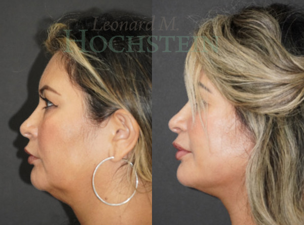 Facelift Patient