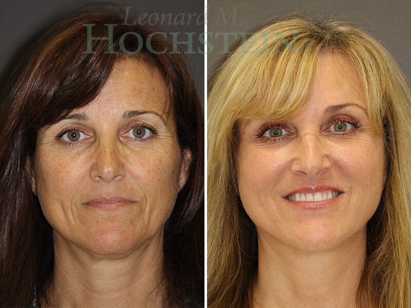 Facelift Patient