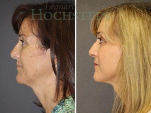 Facelift Patient