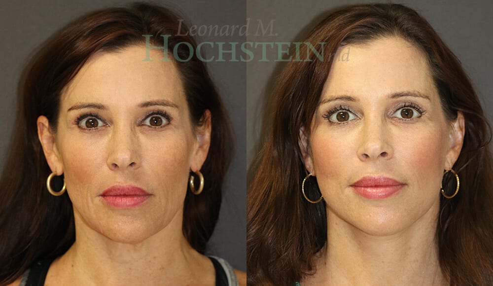Facelift Patient