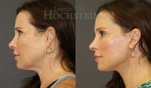 Facelift Patient