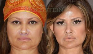 Facelift Patient