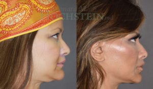 Facelift Patient