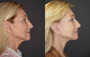Facelift Patient