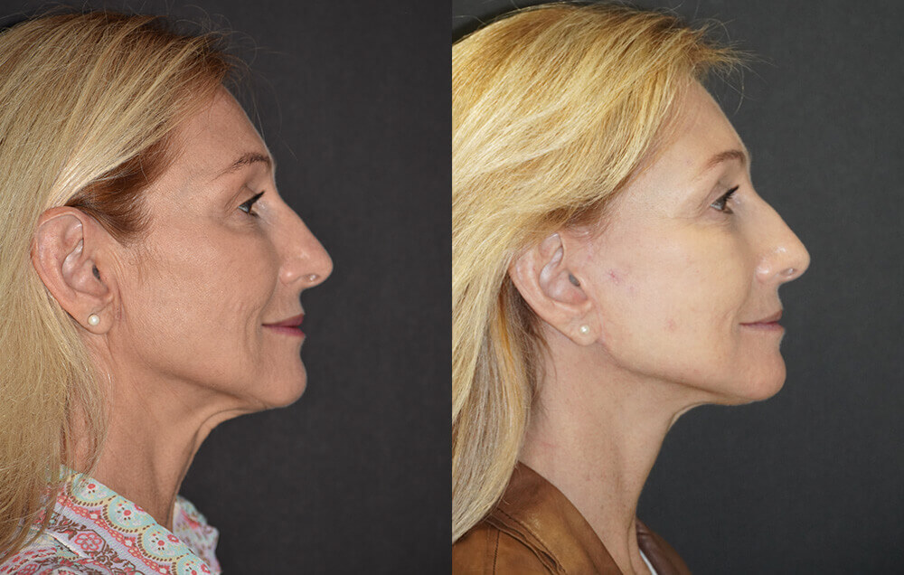 Facelift Patient
