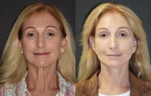 Facelift Patient
