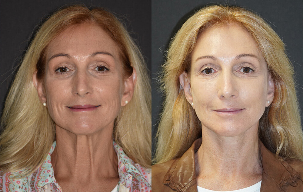 Facelift Patient