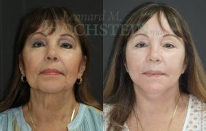 Face Lift Patient 31
