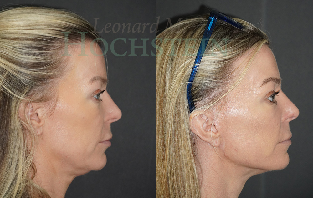 Facelift Patient