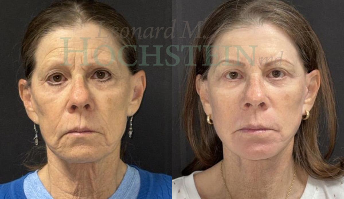 Facelift Patient