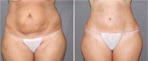 Tummy Tuck Patient