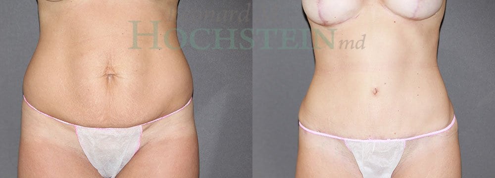 Tummy Tuck Patient