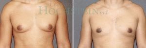 Gynecomastia Patient 01