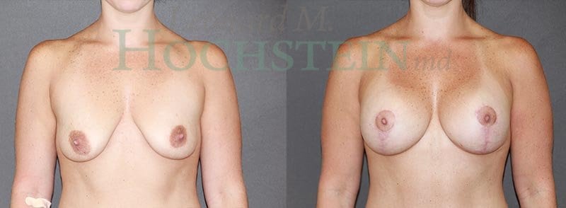 Breast Lift With Implants Patient