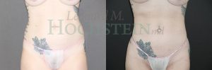 Liposuction Patient