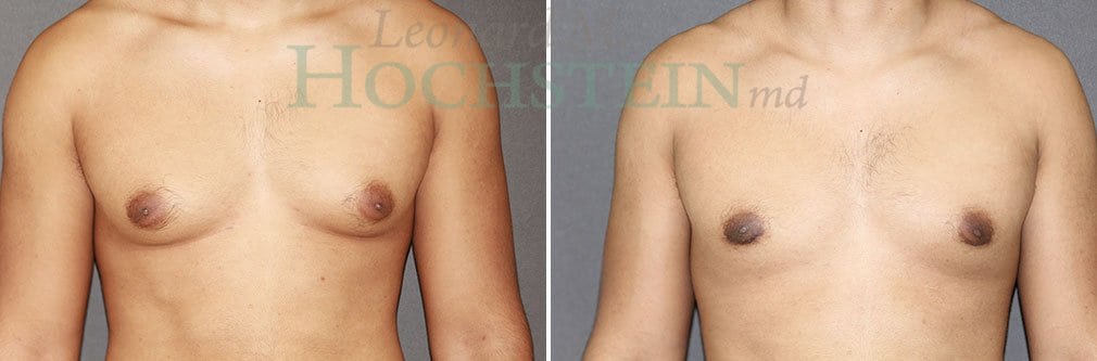 Gynecomastia Patient