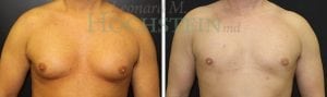 Gynecomastia Patient