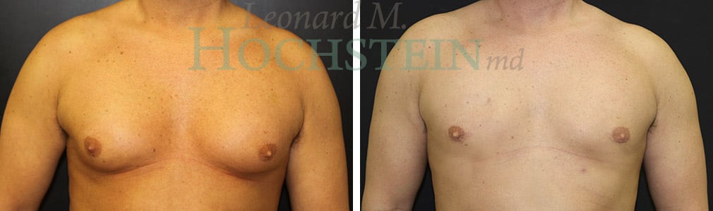 Gynecomastia - Male Breast Reduction, Miami, FL