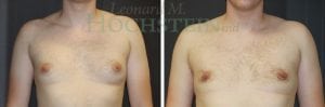 Gynecomastia Patient