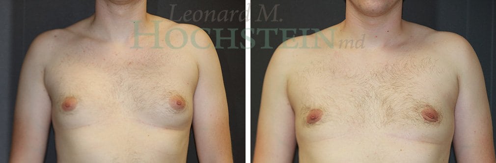 Gynecomastia Patient