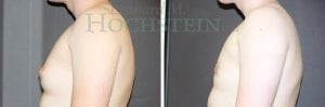 Gynecomastia Patient