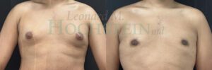 Gynecomastia Patient 07