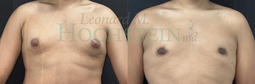 Gynecomastia Patient