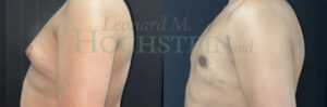 Gynecomastia Patient