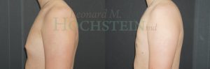 Gynecomastia Patient 06