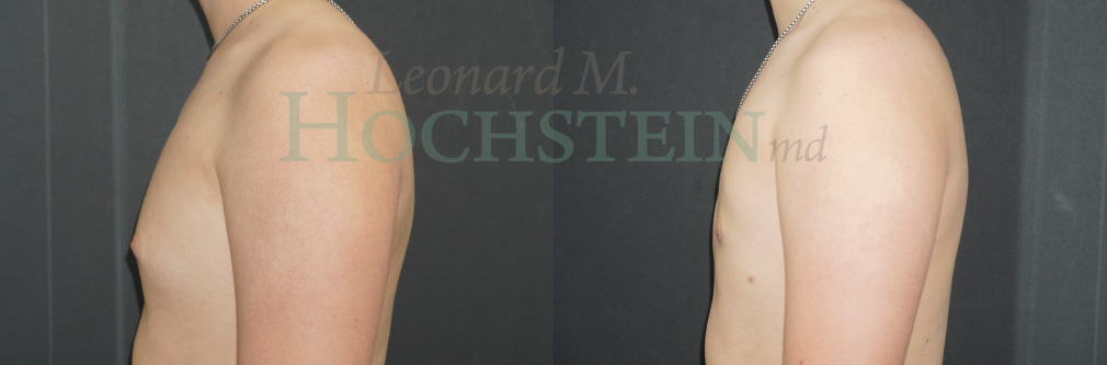 Gynecomastia Patient