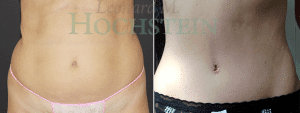 Tummy Tuck Patient 08