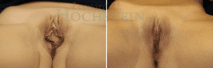 Labiaplasty Patient 01