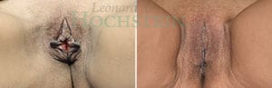 Labiaplasty Patient