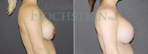 Breast Lift With Implants Patient