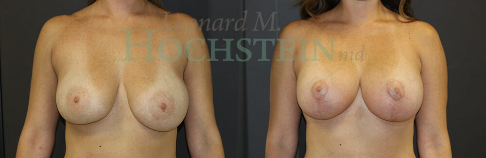 Breast Lift With Implants Patient