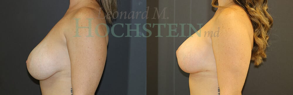 Breast Lift With Implants Patient
