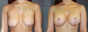 Breast Lift With Implants Patient